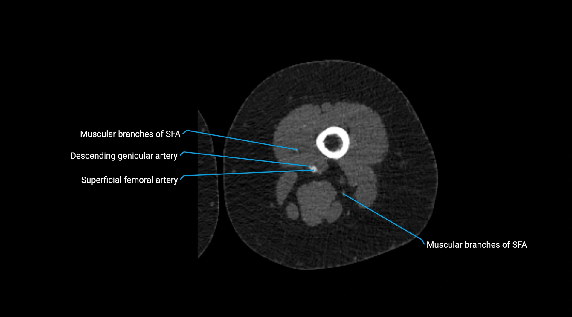 CTA lower limb cross sectional anatomy labelled image _144.webp